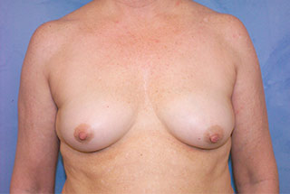 Silicone Breast Augmentation (Augmentation Mammoplasty)