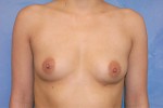 Silicone Breast Augmentation (Augmentation Mammoplasty)