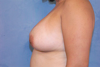 Silicone Breast Augmentation (Augmentation Mammoplasty)