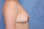 Silicone Breast Augmentation (Augmentation Mammoplasty)