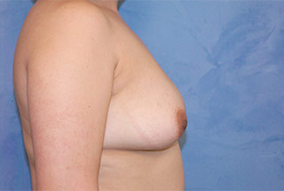 Silicone Breast Augmentation (Augmentation Mammoplasty)