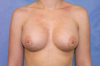 Silicone Breast Augmentation (Augmentation Mammoplasty)