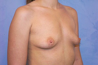 Silicone Breast Augmentation (Augmentation Mammoplasty)