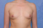 Silicone Breast Augmentation (Augmentation Mammoplasty)