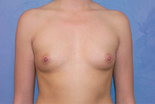 Silicone Breast Augmentation (Augmentation Mammoplasty)