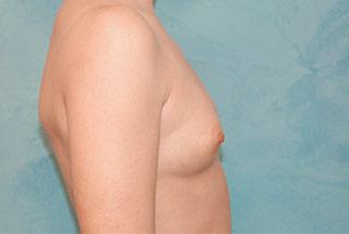 Silicone Breast Augmentation (Augmentation Mammoplasty)