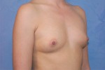 Silicone Breast Augmentation (Augmentation Mammoplasty)