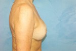 Silicone Breast Augmentation (Augmentation Mammoplasty)