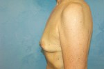 Silicone Breast Augmentation (Augmentation Mammoplasty)