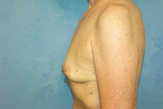 Silicone Breast Augmentation (Augmentation Mammoplasty)