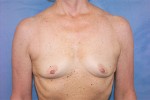 Silicone Breast Augmentation (Augmentation Mammoplasty)