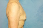 Silicone Breast Augmentation (Augmentation Mammoplasty)