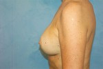 Silicone Breast Augmentation (Augmentation Mammoplasty)