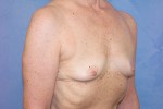 Silicone Breast Augmentation (Augmentation Mammoplasty)