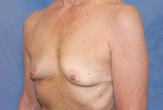 Silicone Breast Augmentation (Augmentation Mammoplasty)