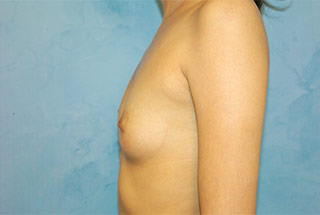 Silicone Breast Augmentation (Augmentation Mammoplasty)