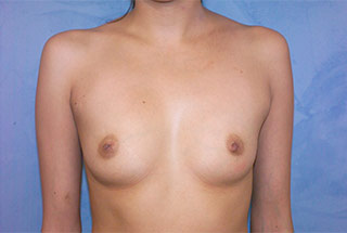 Silicone Breast Augmentation (Augmentation Mammoplasty)