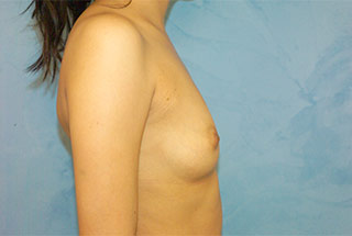 Silicone Breast Augmentation (Augmentation Mammoplasty)