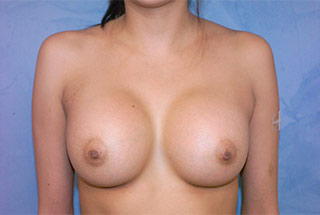 Silicone Breast Augmentation (Augmentation Mammoplasty)