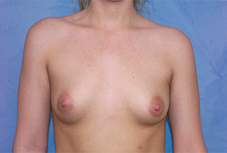 Silicone Breast Augmentation (Augmentation Mammoplasty)