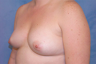 Silicone Breast Augmentation (Augmentation Mammoplasty)