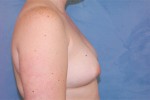 Silicone Breast Augmentation (Augmentation Mammoplasty)