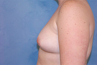 Silicone Breast Augmentation (Augmentation Mammoplasty)