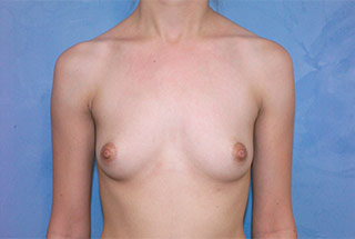 Silicone Breast Augmentation (Augmentation Mammoplasty)