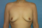 Silicone Breast Augmentation (Augmentation Mammoplasty)