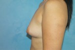 Silicone Breast Augmentation (Augmentation Mammoplasty)