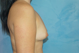 Silicone Breast Augmentation (Augmentation Mammoplasty)