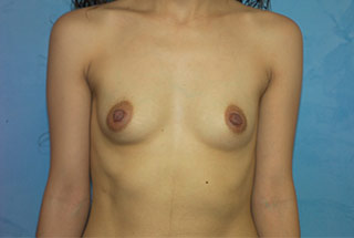 Silicone Breast Augmentation (Augmentation Mammoplasty)