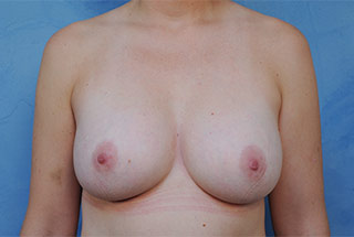 Silicone Breast Augmentation (Augmentation Mammoplasty)