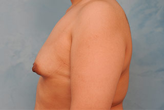 Silicone Breast Augmentation (Augmentation Mammoplasty)