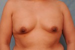 Silicone Breast Augmentation (Augmentation Mammoplasty)