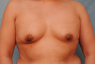 Silicone Breast Augmentation (Augmentation Mammoplasty)