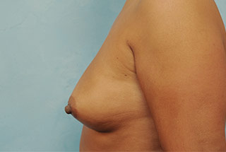 Silicone Breast Augmentation (Augmentation Mammoplasty)