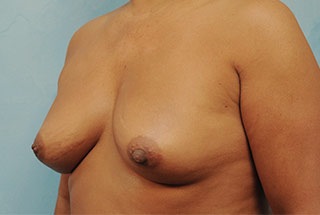 Silicone Breast Augmentation (Augmentation Mammoplasty)