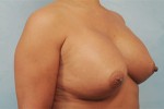 Silicone Breast Augmentation (Augmentation Mammoplasty)