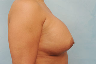 Silicone Breast Augmentation (Augmentation Mammoplasty)