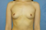 Saline Breast Augmentation (Augmentation Mammoplasty)