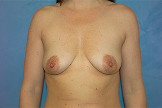 Saline Breast Augmentation (Augmentation Mammoplasty)