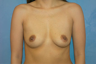 Saline Breast Augmentation (Augmentation Mammoplasty)