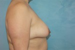 Saline Breast Augmentation (Augmentation Mammoplasty)