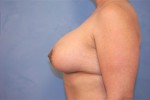 Saline Breast Augmentation (Augmentation Mammoplasty)