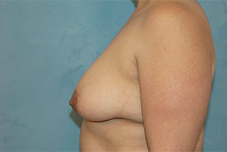 Saline Breast Augmentation (Augmentation Mammoplasty)