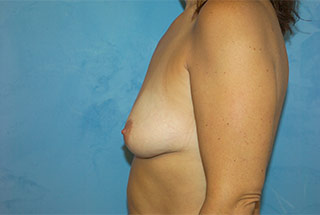 Saline Breast Augmentation (Augmentation Mammoplasty)