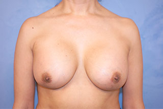 Saline Breast Augmentation (Augmentation Mammoplasty)