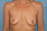 Saline Breast Augmentation (Augmentation Mammoplasty)