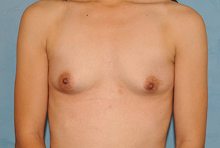 Saline Breast Augmentation (Augmentation Mammoplasty)